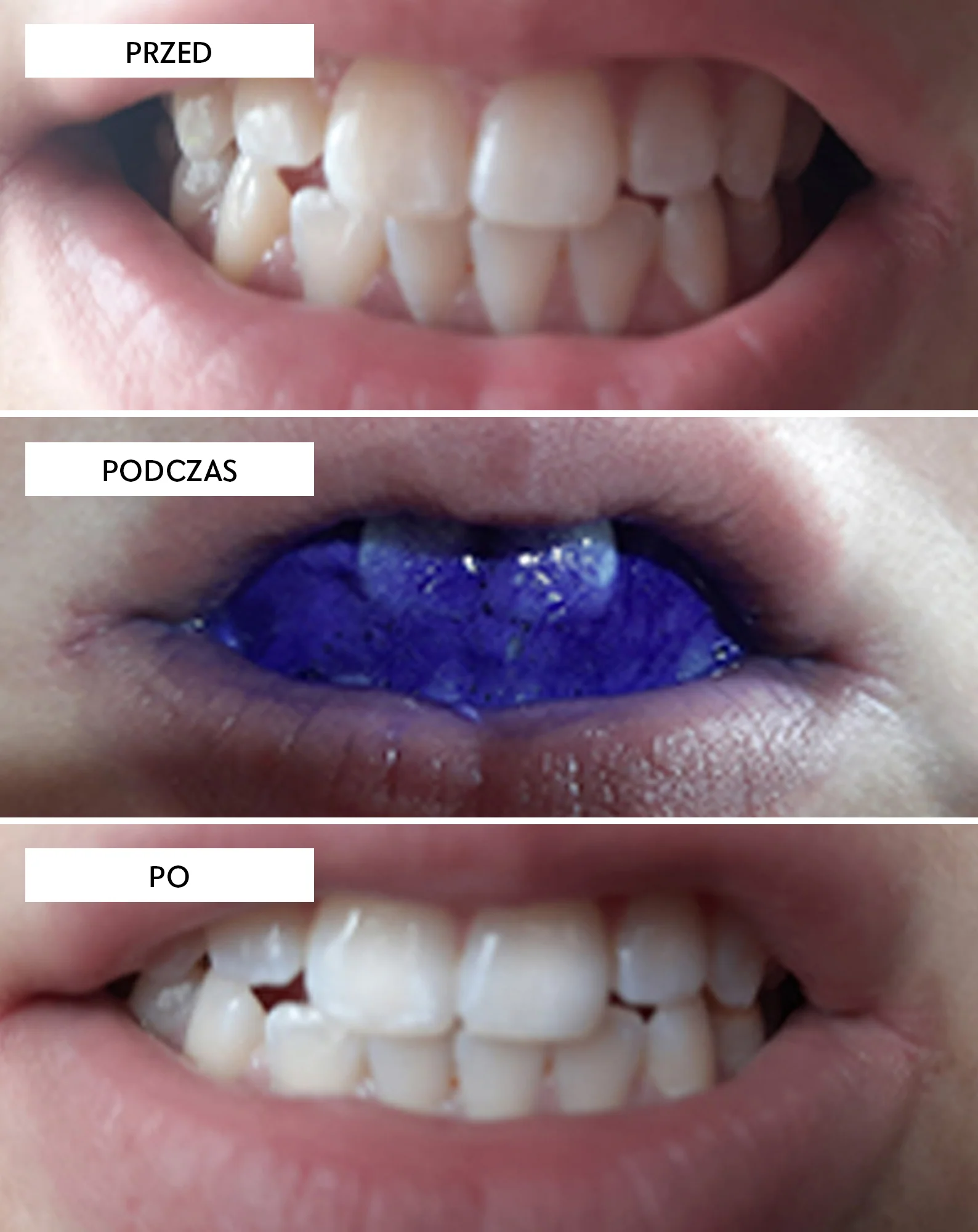 Korektor koloru serum korygujące kolor zębów White Bite Smilebite 30 ml - Image 3
